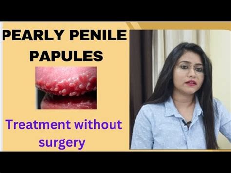 papule penienne|Diagnosis and Management of Pearly Penile Papules